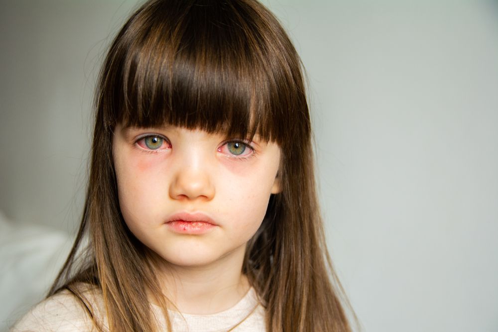 Conjunctivitis Demystified: How to Identify, Treat, and Prevent Pink Eye