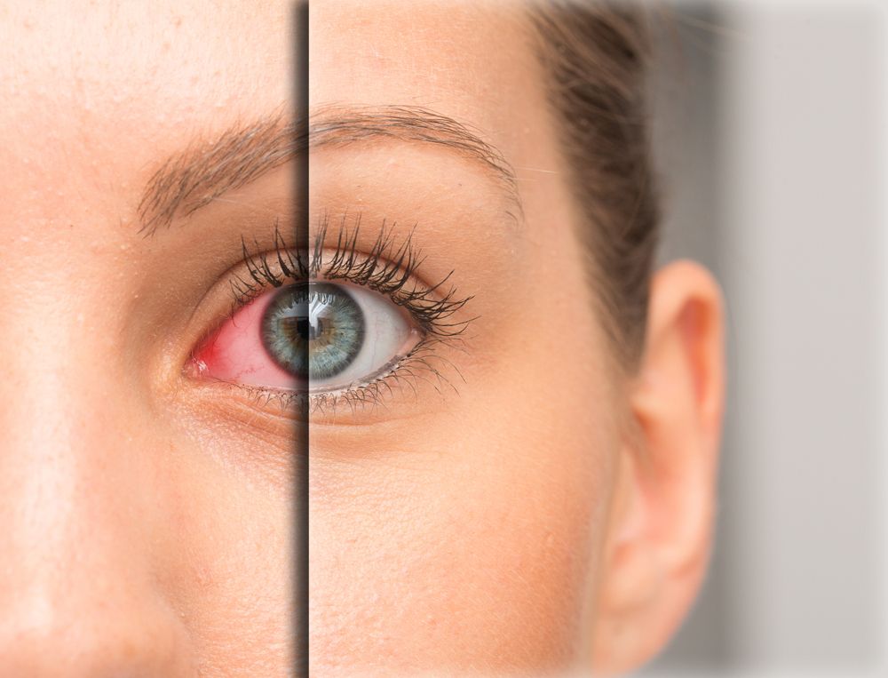 Relief for Red Eyes: Effective Treatment Options Explained