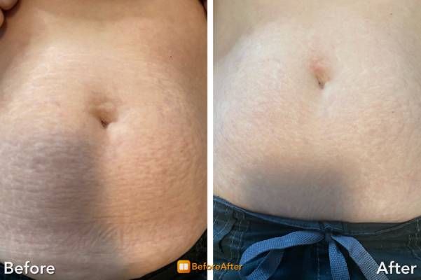 Before and After stretch marks