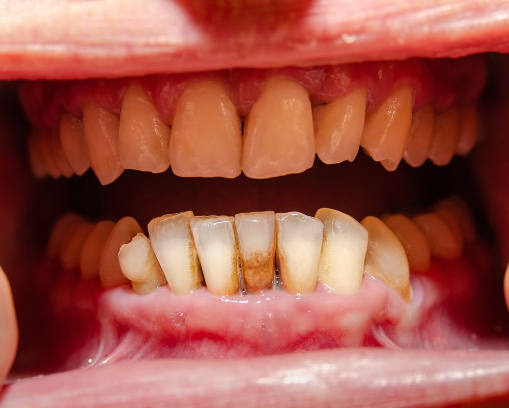 Stages of Gum Disease (Periodontitis)