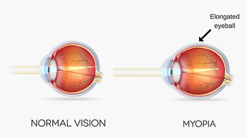 Elongated Eye in Myopia