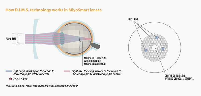 MiyoSmart Lens