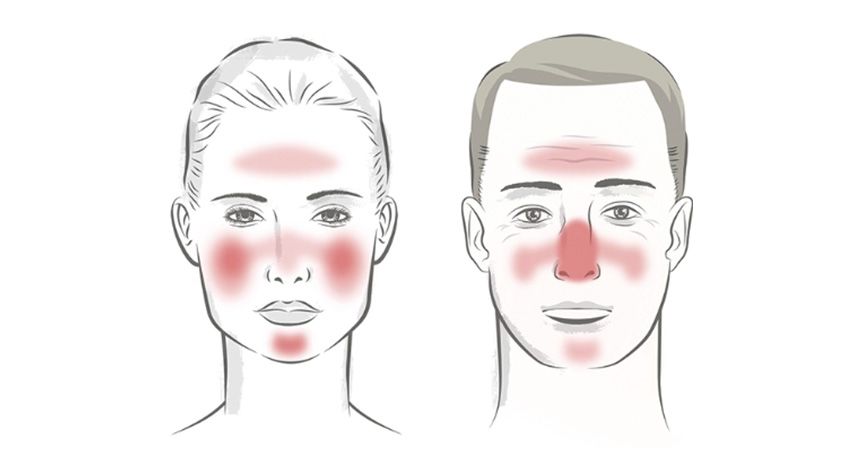 Facial Rosacea and Dry Eye Disease
