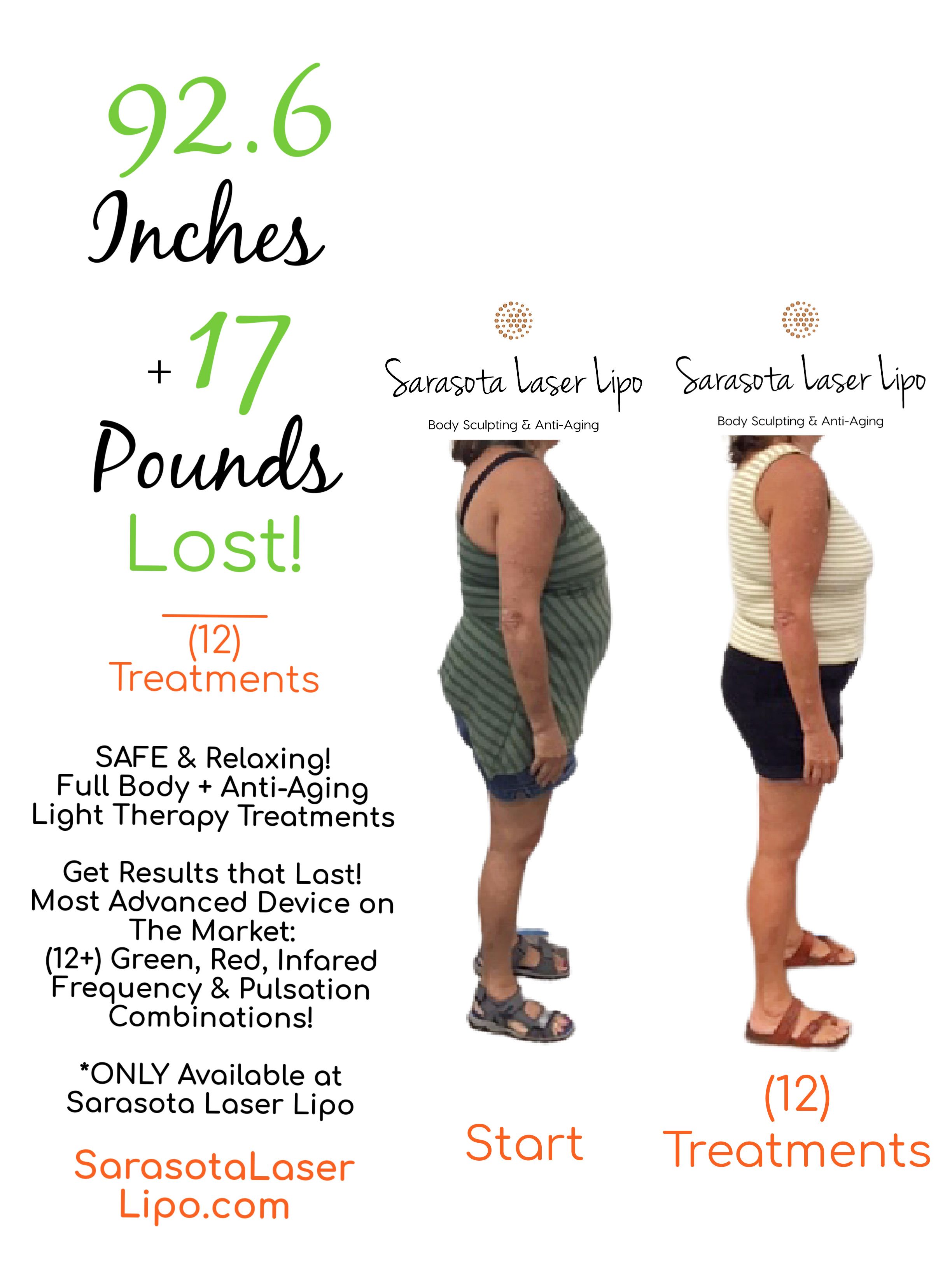 Weight Loss in Sarasota FL Before & After Sarasota Laser Lipo
