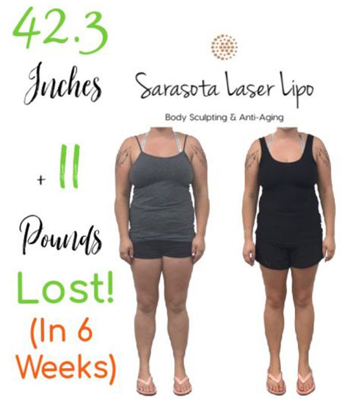 Weight Loss in Sarasota FL Before & After Sarasota Laser Lipo