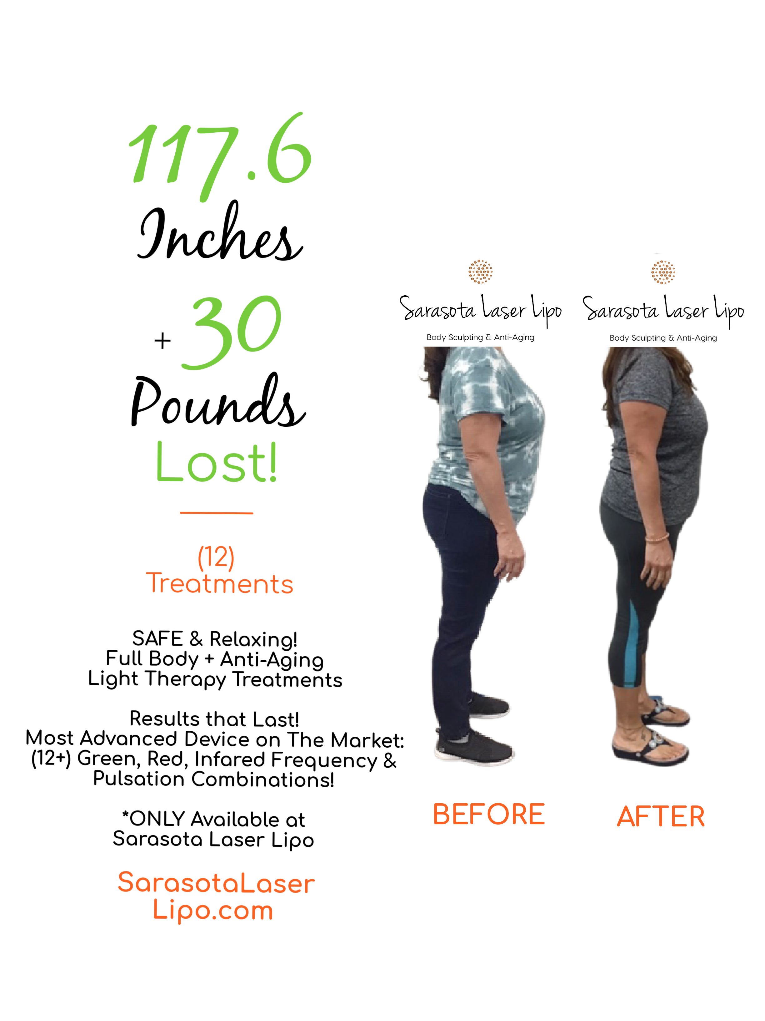 Weight Loss in Sarasota FL Before & After Sarasota Laser Lipo