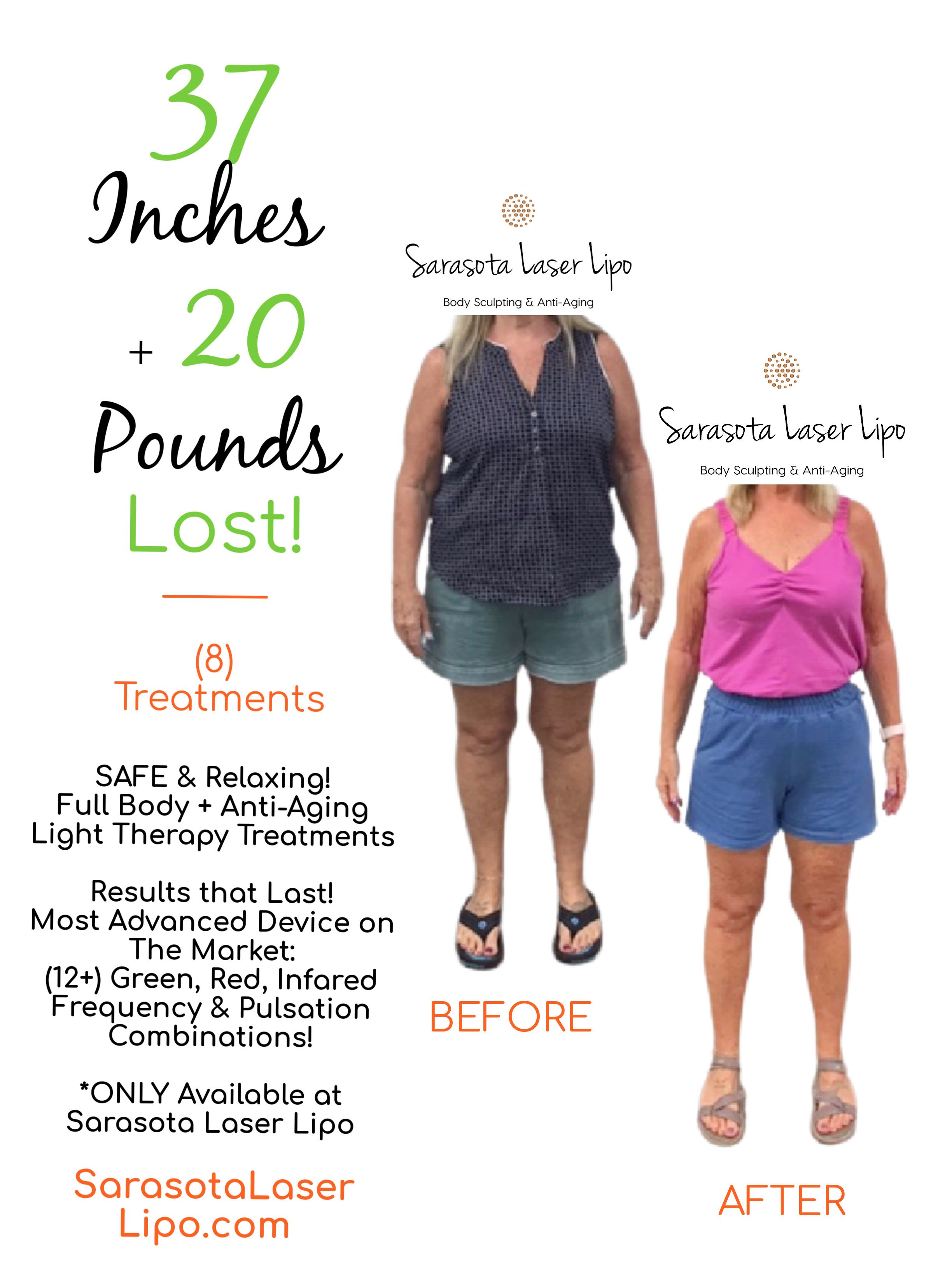 Weight Loss in Sarasota FL Before & After Sarasota Laser Lipo