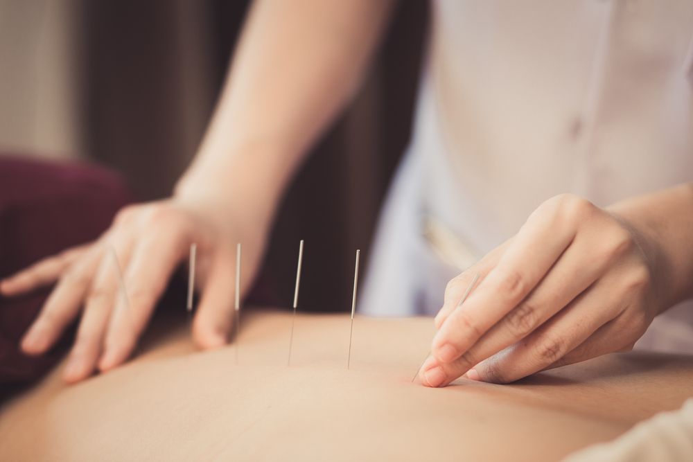 Point and Align: The Dynamic Duo of Acupuncture and Chiropractic Care