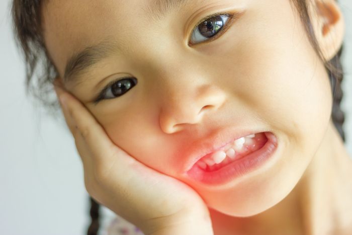 Abscessed Tooth in Children: Care Instructions 