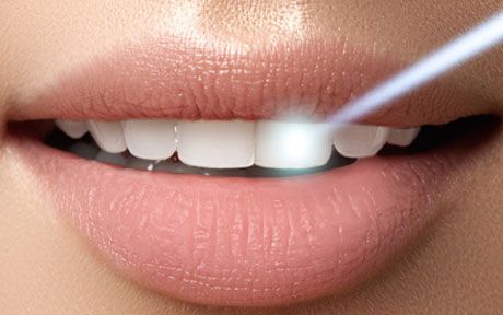 E4D Porcelain RestorationLaser Technology