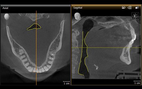 CBCT Scan