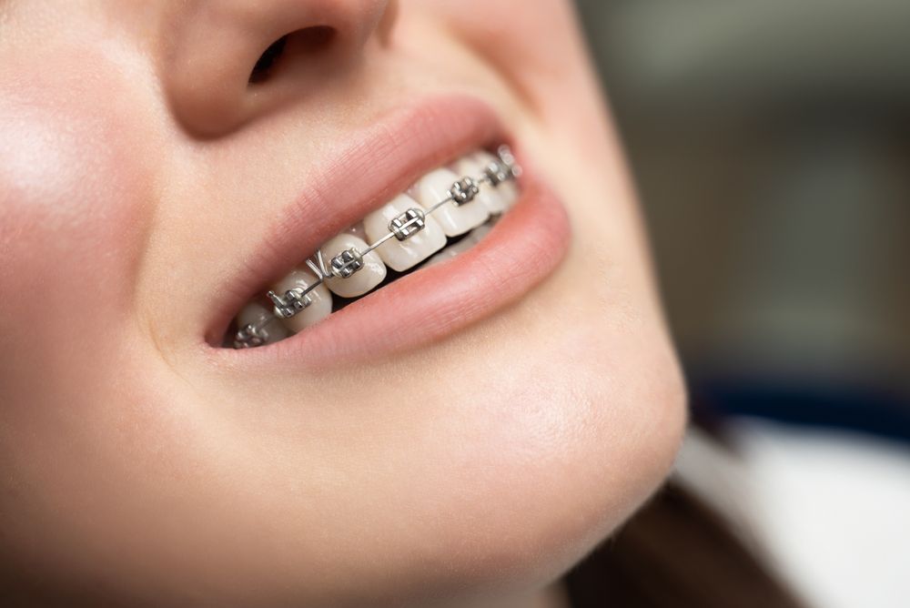 Advantages of Clear Aligners vs. Braces?