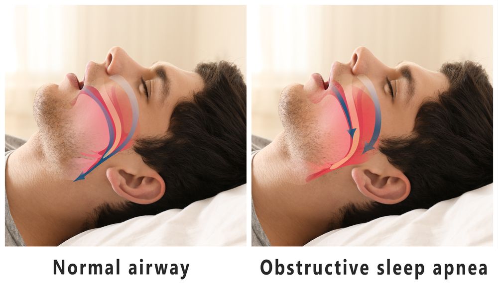 The Dangers of Uncontrolled Sleep Apnea