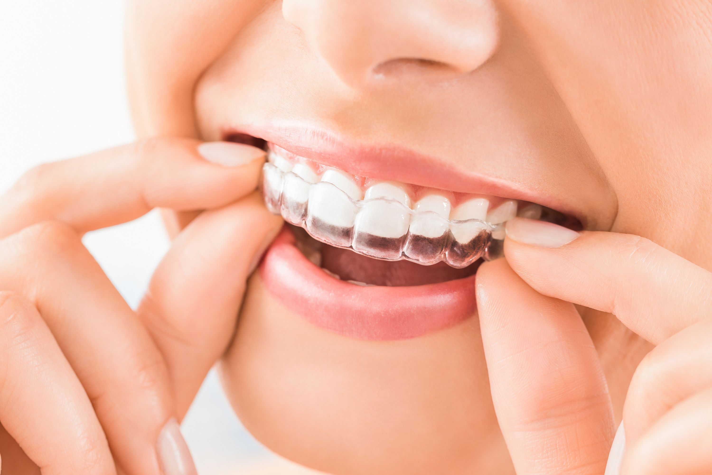 5 Benefits of Invisalign Over Traditional Braces