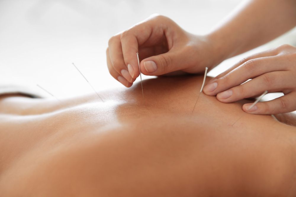 The Things You Need To Know About Acupuncture
