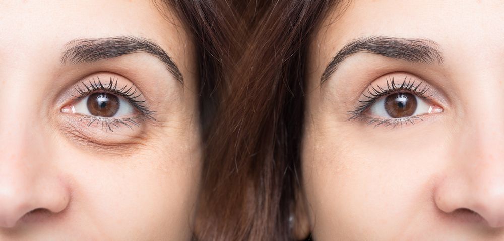 How Eyelid Surgery Can Transform Your Appearance