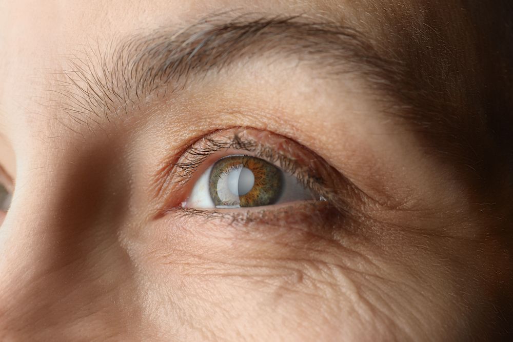 Signs and Symptoms of Cataracts