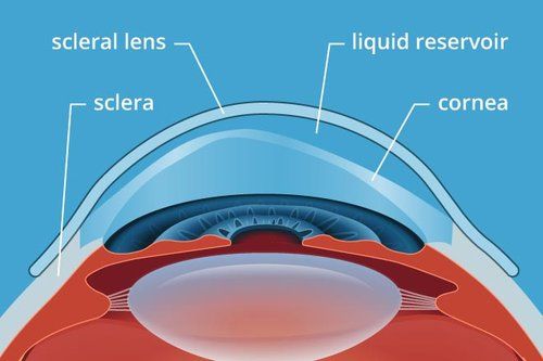 specialty contact lenses