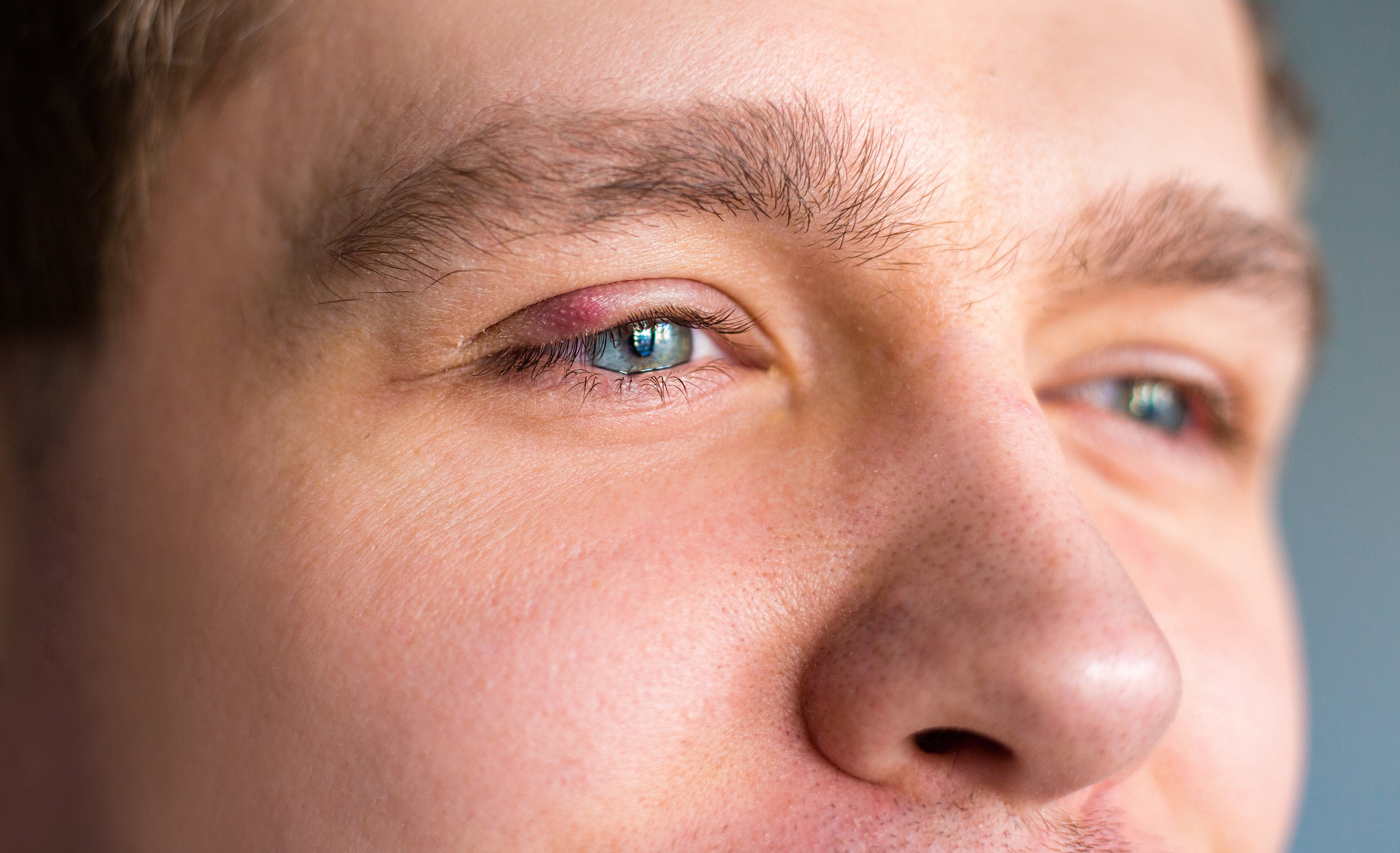 What Is a Stye, and How Is It Treated?