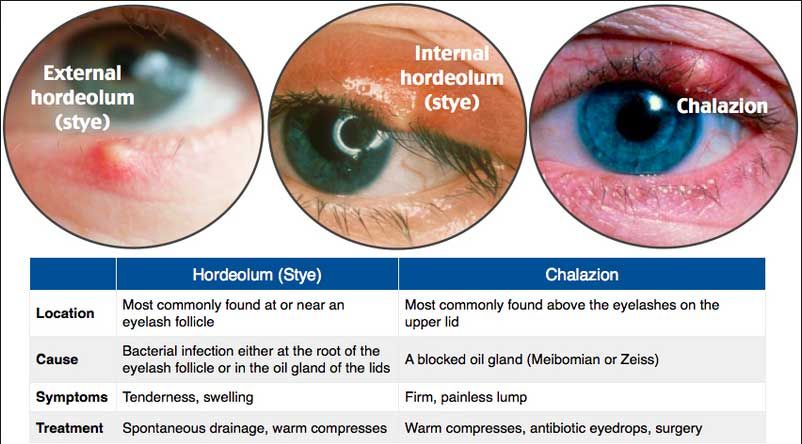 eyelid at Vision Eye Max, LLC, in Katy, TX