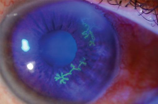 cornea at Vision Eye Max, LLC, in Katy, TX