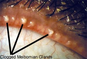 eyelid at Vision Eye Max, LLC, in Katy, TX