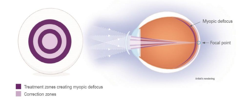 myopia control at Vision Eye Max, LLC, in Katy, TX