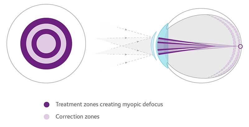 myopia control at Vision Eye Max, LLC, in Katy, TX