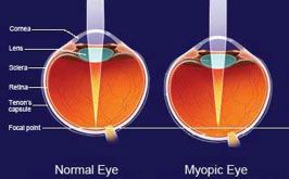 myopia control at Vision Eye Max, LLC, in Katy, TX
