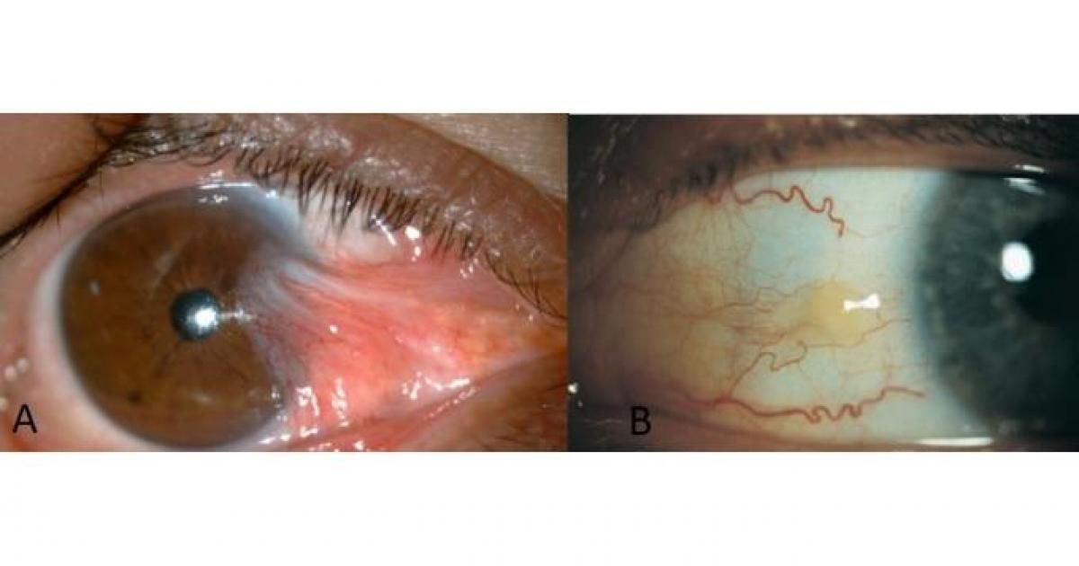 conjunctiva at Vision Eye Max, LLC, in Katy, TX