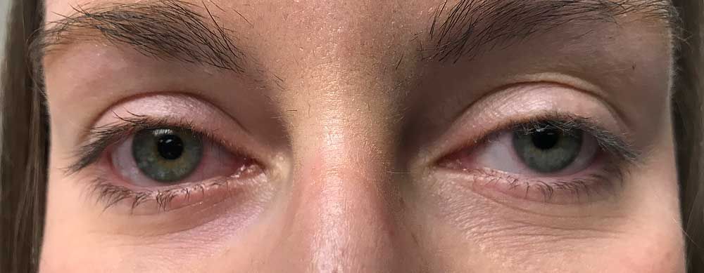 eyelid at Vision Eye Max, LLC, in Katy, TX