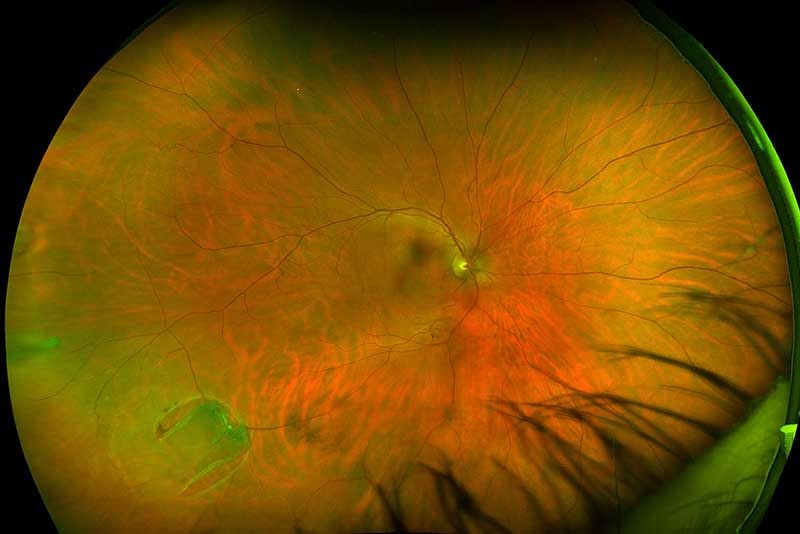 retina at Vision Eye Max, LLC, in Katy, TX