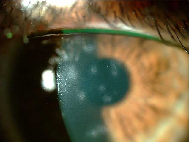 cornea at Vision Eye Max, LLC, in Katy, TX