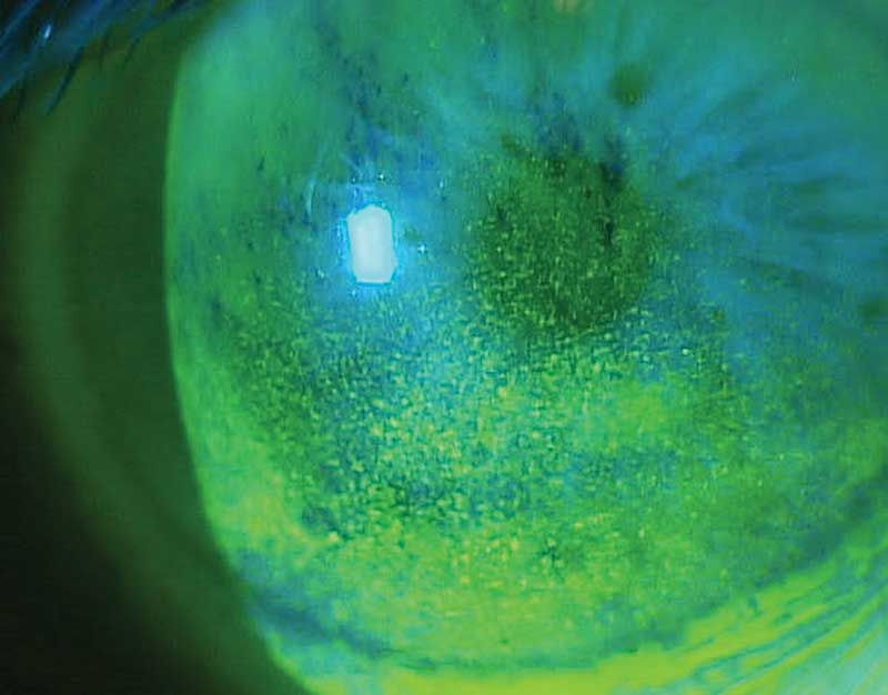 cornea at Vision Eye Max, LLC, in Katy, TX