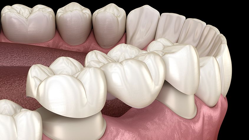 Crown and Veneers