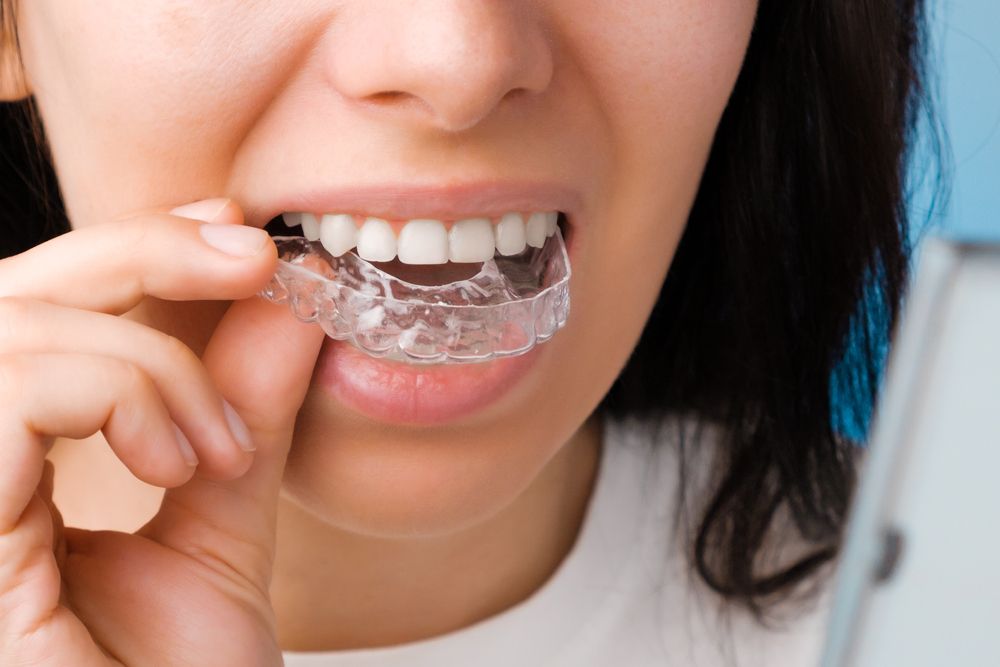 Is Teeth Whitening Safe with Invisalign?