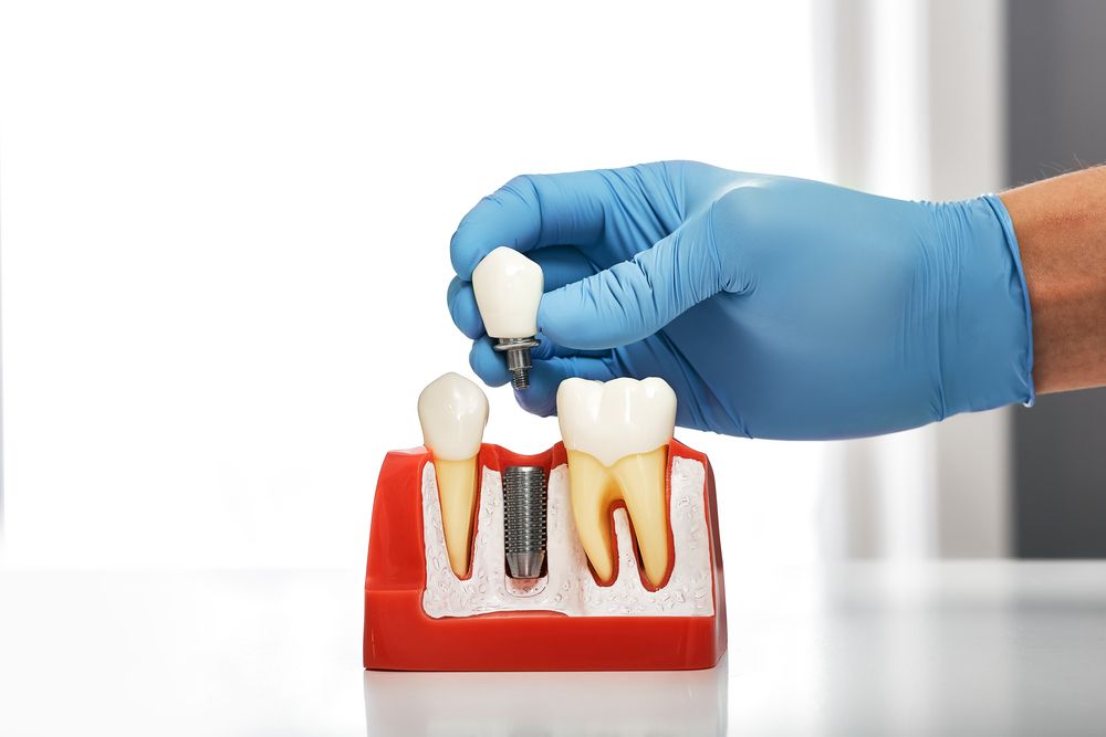 What Are the Options for Replacing a Missing Tooth?