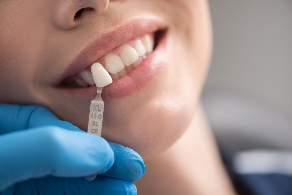 Are You a Candidate for Dental Implants?