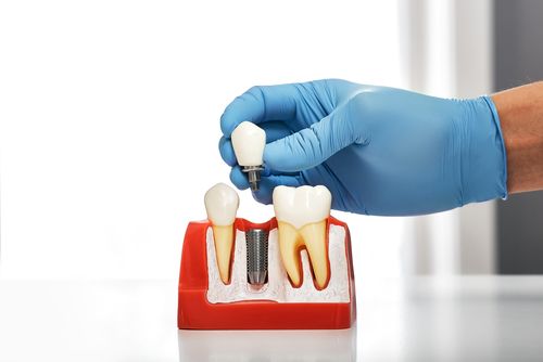5 Signs You May Need Dental Implants