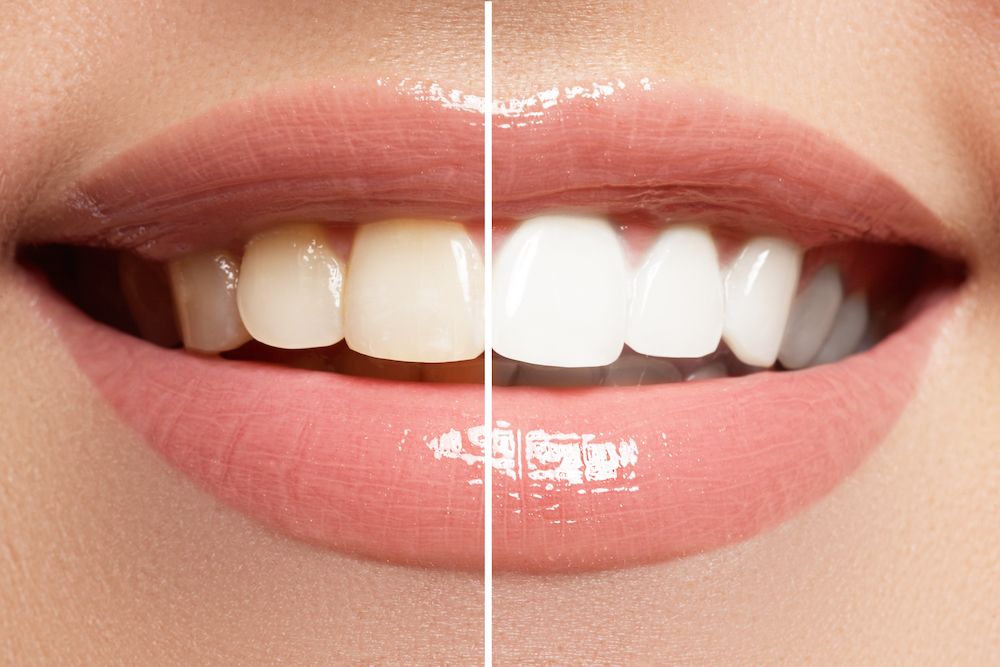 The Benefits of Professional Teeth Whitening Treatments