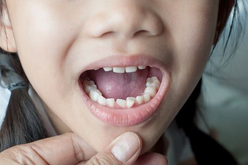 Overcrowded Teeth: Causes, Symptoms, and Treatment