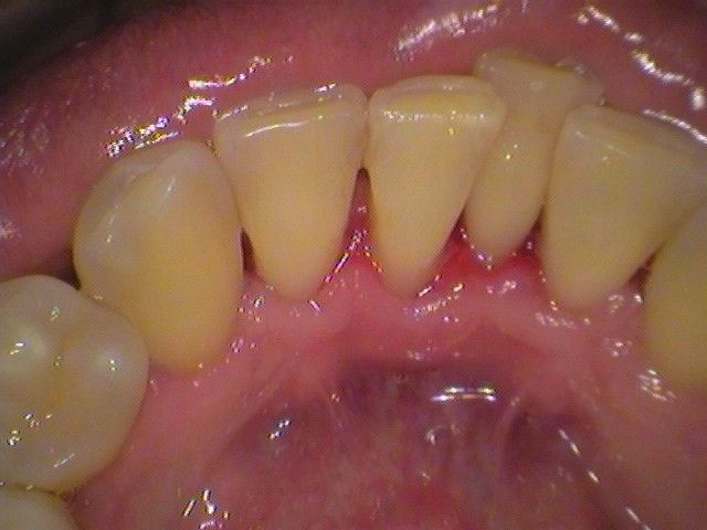 after cosmetic dentistry