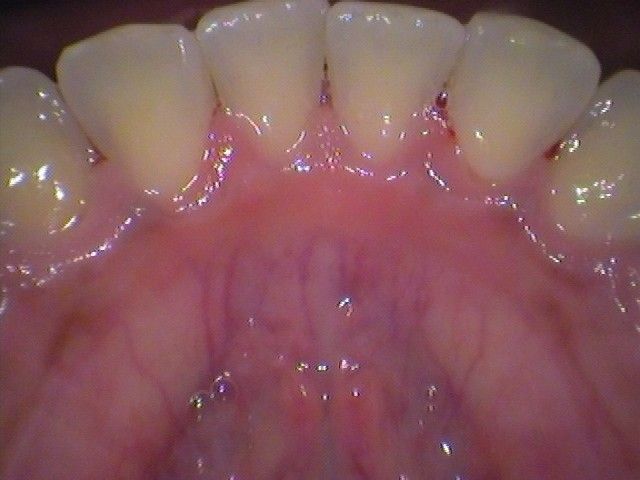 after cosmetic dentistry