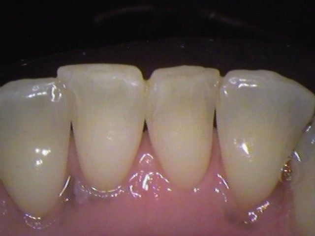 after cosmetic dentistry