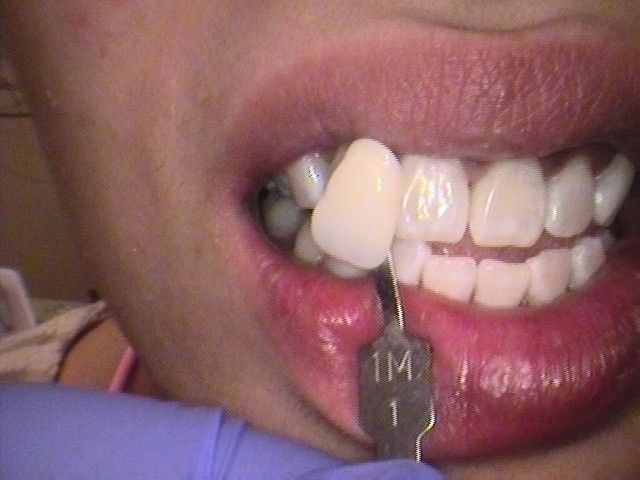 after cosmetic dentistry