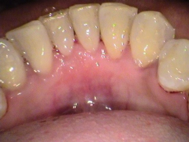 after cosmetic dentistry