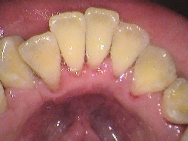 after cosmetic dentistry