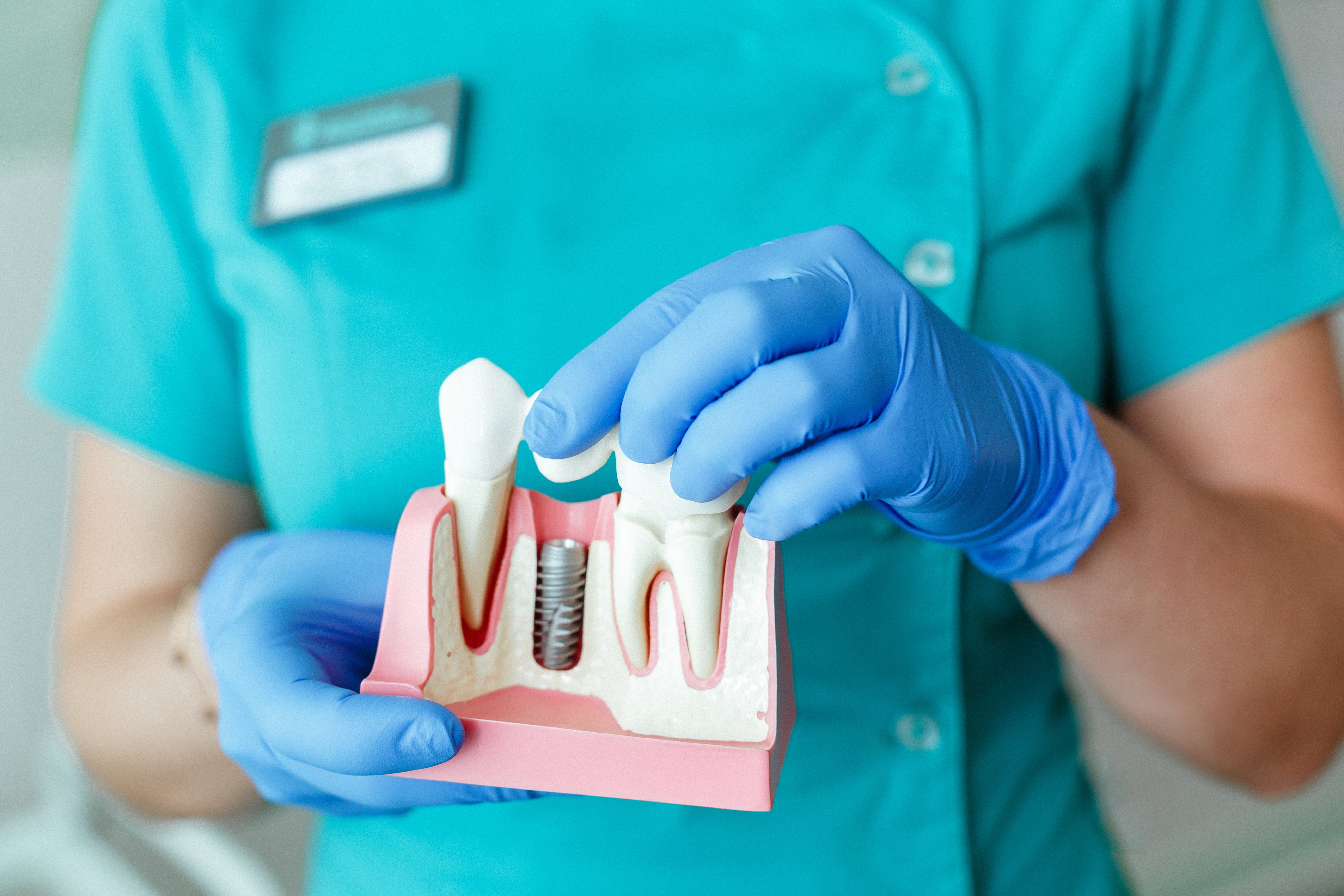 The Different Types of Dental Implants