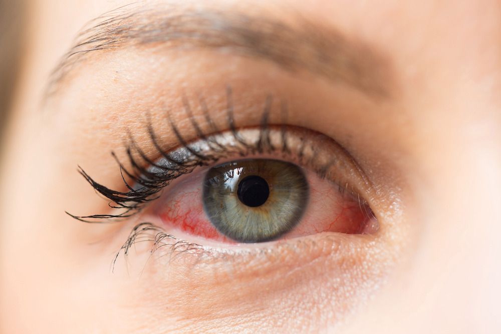 The Benefits of Punctal Plugs for Dry Eye Syndrome