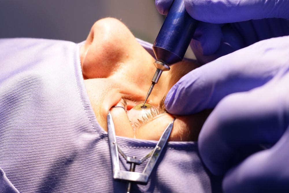 LASIK Surgery: A Comprehensive Guide to Understanding the Procedure